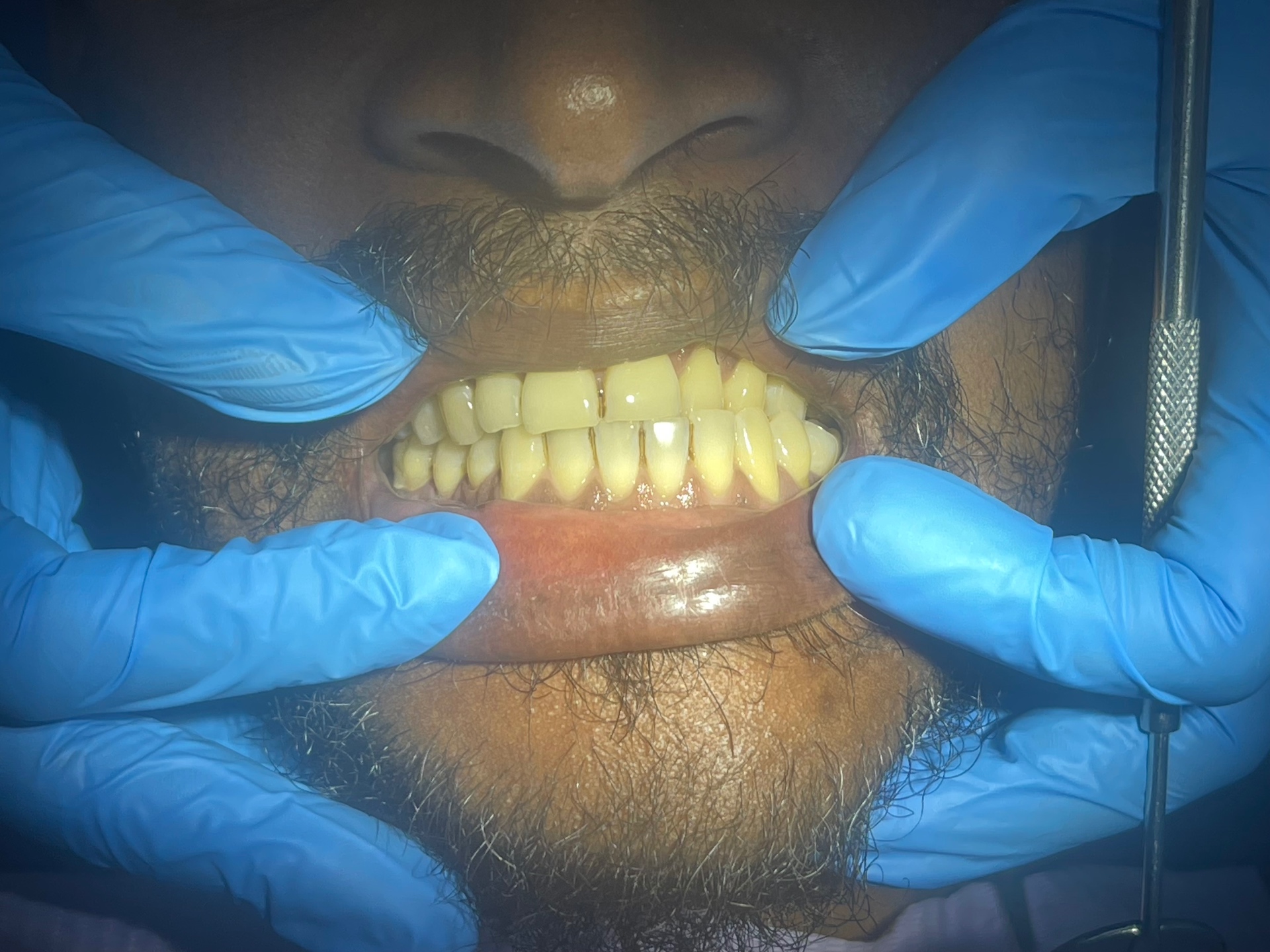 Before Scaling & Polishing